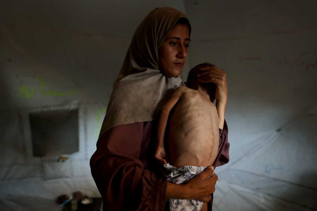 TOPSHOT-PALESTINIAN-ISRAEL-CONFLICT-MALNUTRITION famine in gaza